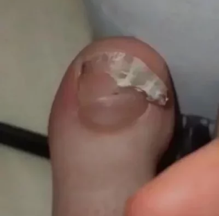 Nagelreconstructie