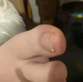 Nagelreconstructie